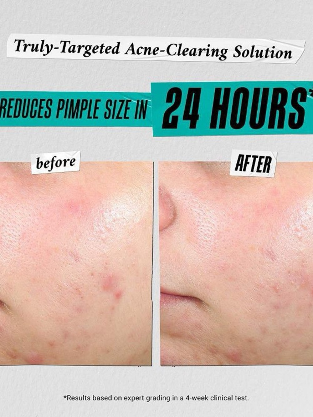 Kiehl's Ditch the Zituation- Acne Kit NWT - Picture 10 of 11